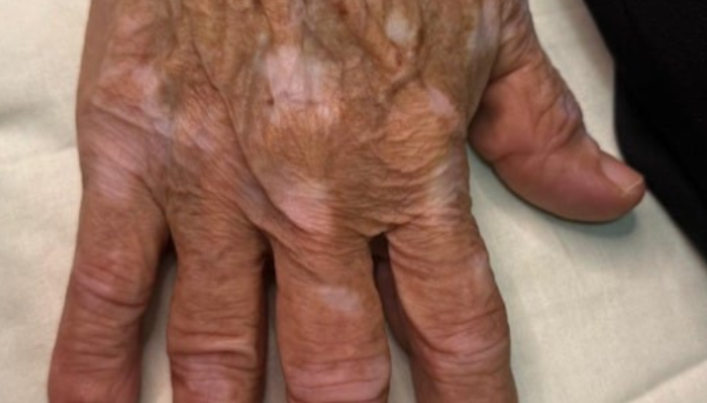 Antes: Camuflagem de Vitiligo